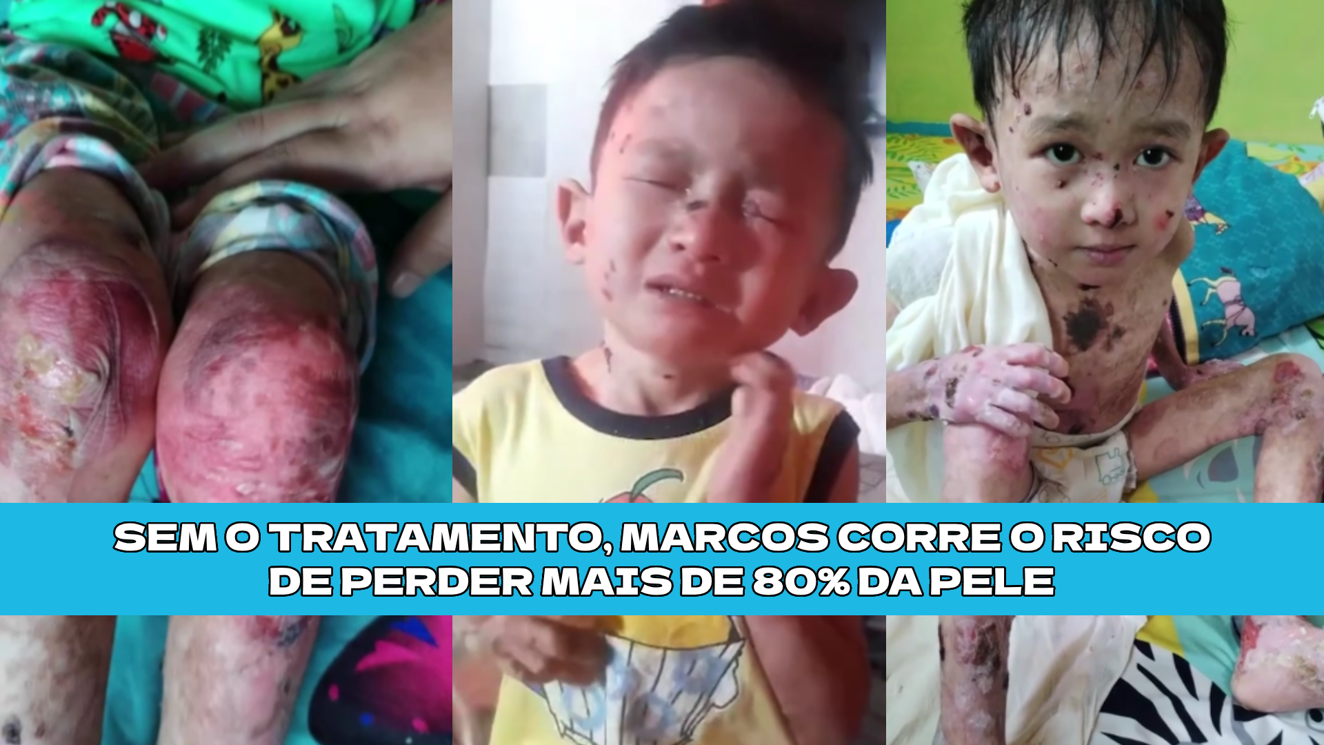 Marcos precisa de ajuda contra a Epidermólise Bolhosa