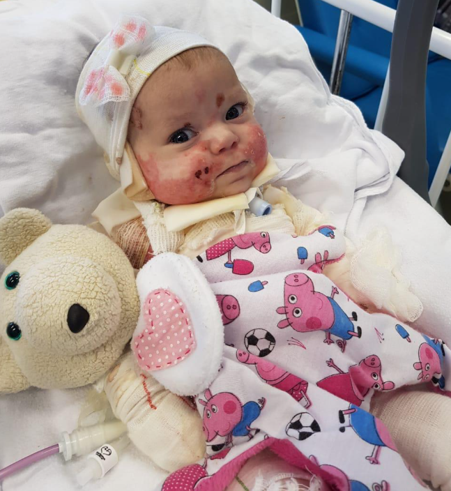 Ajude a Helena, nasceu com doença que a deixa sensível a qualquer toque!